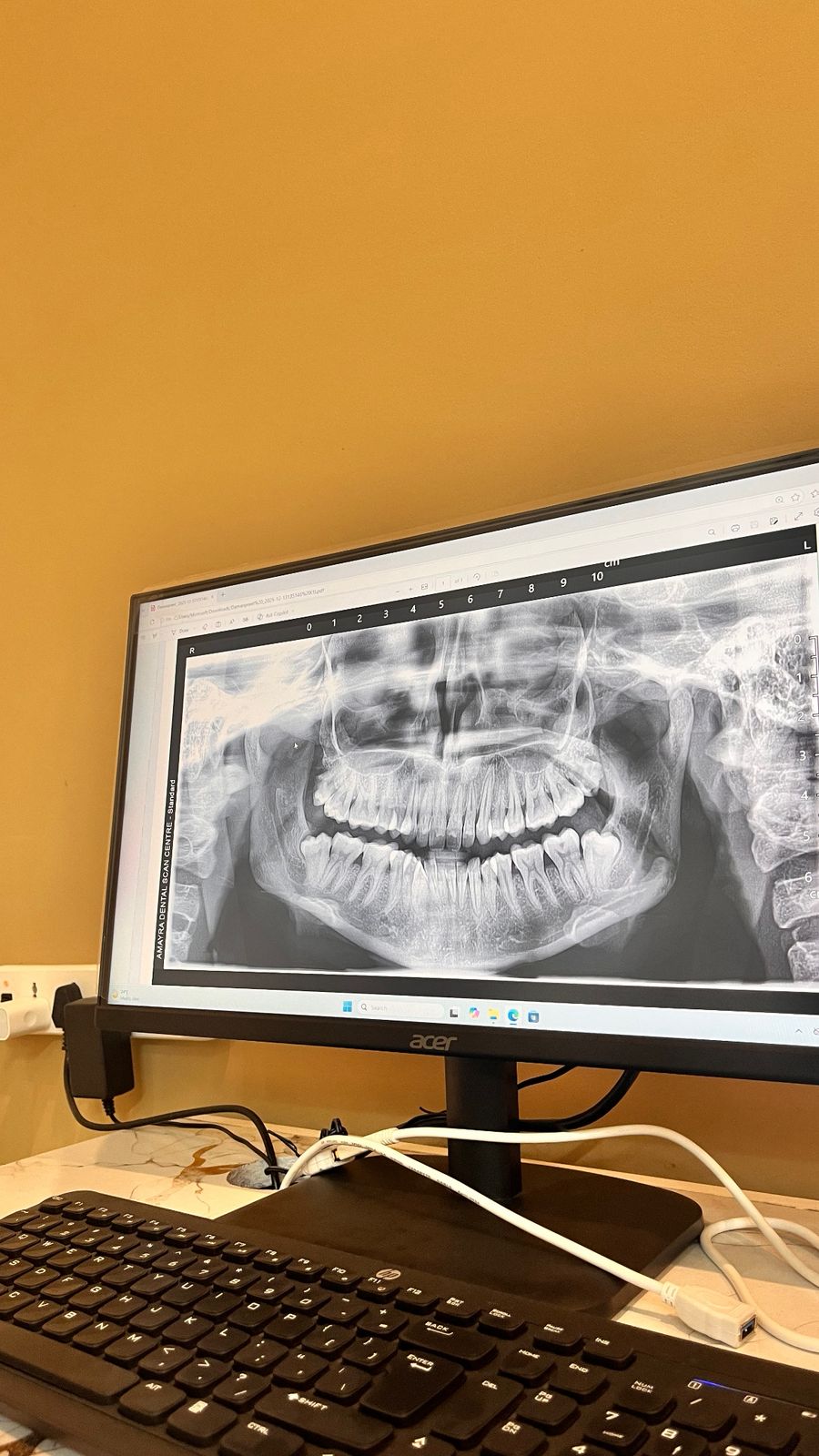Dental implant planning with X-ray