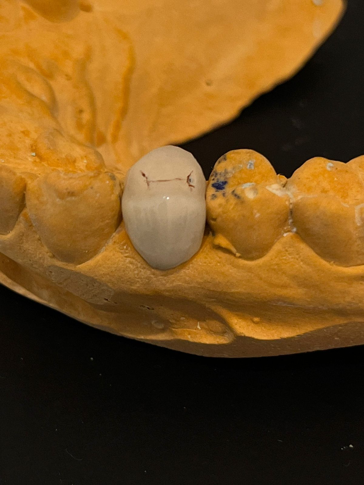 Custom ceramic crown on a dental model